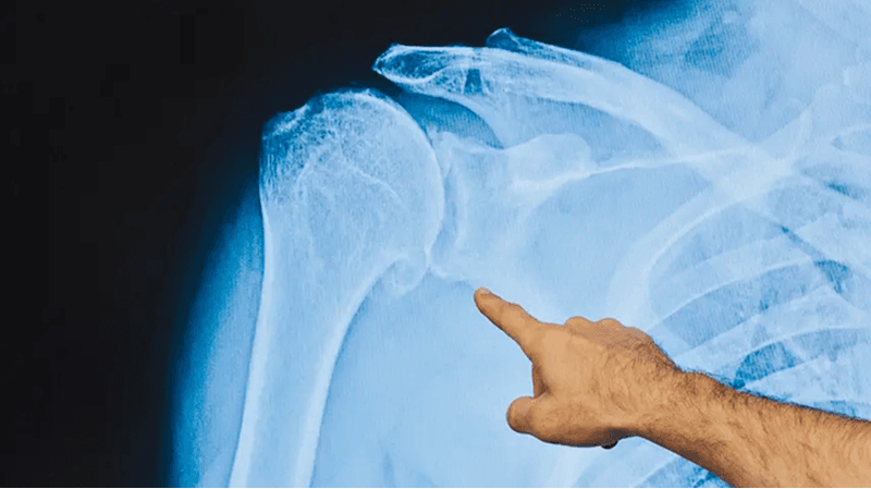 image of a shoulder x-ray